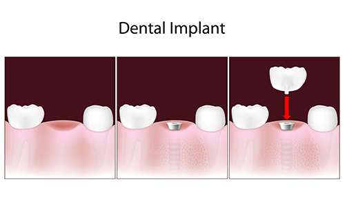 Dental Implants in Yonkers