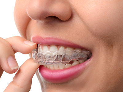 A woman holding a clear plastic retainer with her teeth.