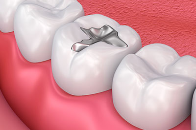 The image shows a close-up view of a dental implant being placed into a prepared tooth socket within an open mouth, with visible teeth on either side.