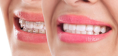 A split-screen image showcasing two different smiles with varying levels of tooth whiteness.