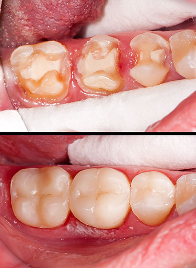 The image shows a side view of an open mouth with severe dental decay, revealing rotten teeth and gums, before and after treatment, emphasizing the transformation from poor oral hygiene to improved dental health.