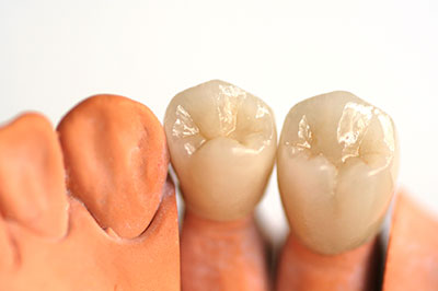 The image shows two artificial teeth placed next to each other against a white background.