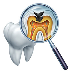 The image shows a magnified view of a human tooth with an open crown, revealing the interior structure including the pulp chamber, root canals, and nerve endings, viewed through a magnifying glass with a transparent handle, set against a white background.