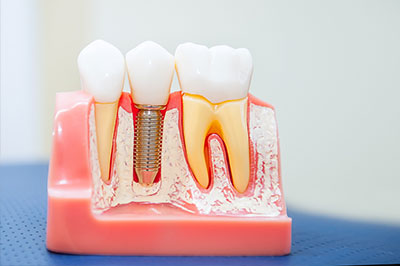 The image shows a model of a human mouth with artificial teeth and gums, featuring an oral implant fixture.