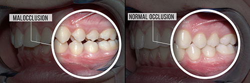 The image shows a side-by-side comparison of a person s teeth with malocclusion before and after treatment, highlighting the improvement provided by dental orthopedics.