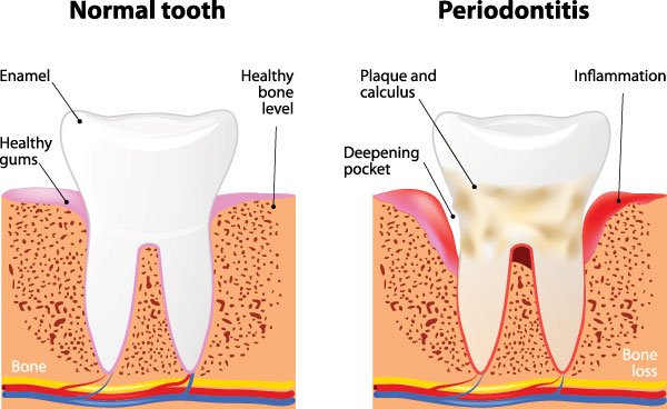 The image depicts a diagrammatic representation of tooth decay stages from normal to periodontitis, illustrating the progression of bone loss around teeth with annotations for healthy, plaque-covered, and decayed states, highlighting the impact of oral hygiene on dental health.