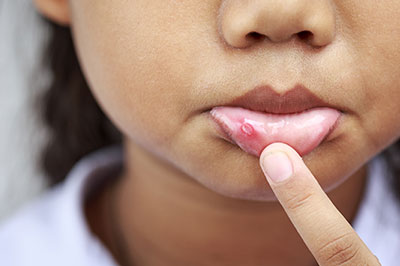 The image shows a young child with a visible red mark on their face, reaching up towards it with their finger.