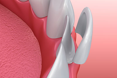 The image shows a close-up view of a dental implant with a pink gum background, highlighting the metallic screws and the surrounding soft tissue.