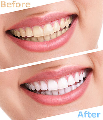 The image displays a side-by-side comparison of a person s teeth before and after a dental treatment, showcasing a noticeable improvement in the brightness and color of the teeth.