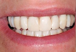 The image shows a close-up of a person s smiling mouth with white teeth, set against a neutral background.