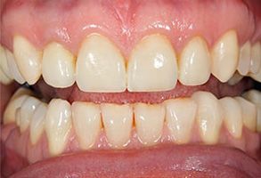 The image shows a close-up view of an individual s teeth with a focus on yellowing and staining, likely for dental care or cosmetic purposes.
