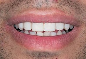 A close-up photograph of a person s smiling face with teeth, lips, and facial hair.