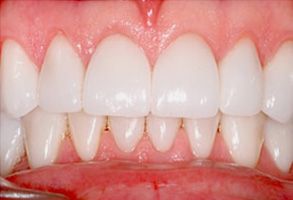 The image shows a close-up of a person s teeth with a focus on dental hygiene, specifically highlighting a clean and well-maintained set of white teeth within a pink gumline.