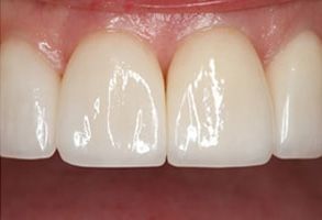 The image shows a close-up view of a person s teeth with a focus on a large gap between the front two teeth, which appear to be missing, set against a background that seems to be a mouth with other teeth and gums.