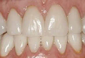 The image shows a close-up view of a person s teeth with a focus on the lower front teeth, which appear to be yellowed or stained, suggesting a need for dental care.