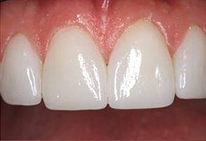 This is a close-up image of a person s teeth with a focus on a bright white smile.