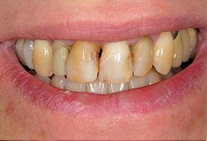 The image shows a close-up of a person s teeth with noticeable staining and discoloration, which appears to be a result of poor oral hygiene or dental issues.