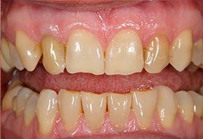The image shows a close-up view of a person s teeth with a focus on a mouth with yellowing, discolored teeth under bright lighting.