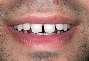 The image shows a close-up of a person s face with a focus on their teeth and lips.