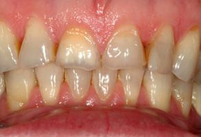The image shows a close-up view of a person s mouth with yellowed teeth and visible tartar buildup, highlighting dental health issues.
