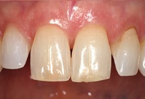 An image displaying a close-up view of a person s teeth with visible signs of decay and discoloration, including missing enamel and yellow staining.