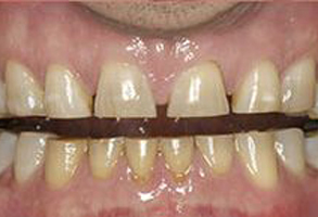 The image shows a close-up view of a set of human teeth with yellow staining, some missing enamel, and a partial bridge or denture in place.
