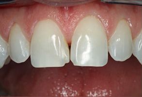 The image shows a close-up view of a person s teeth, with visible dental work such as fillings and possibly braces, against a blurred background that suggests an indoor setting with artificial lighting.